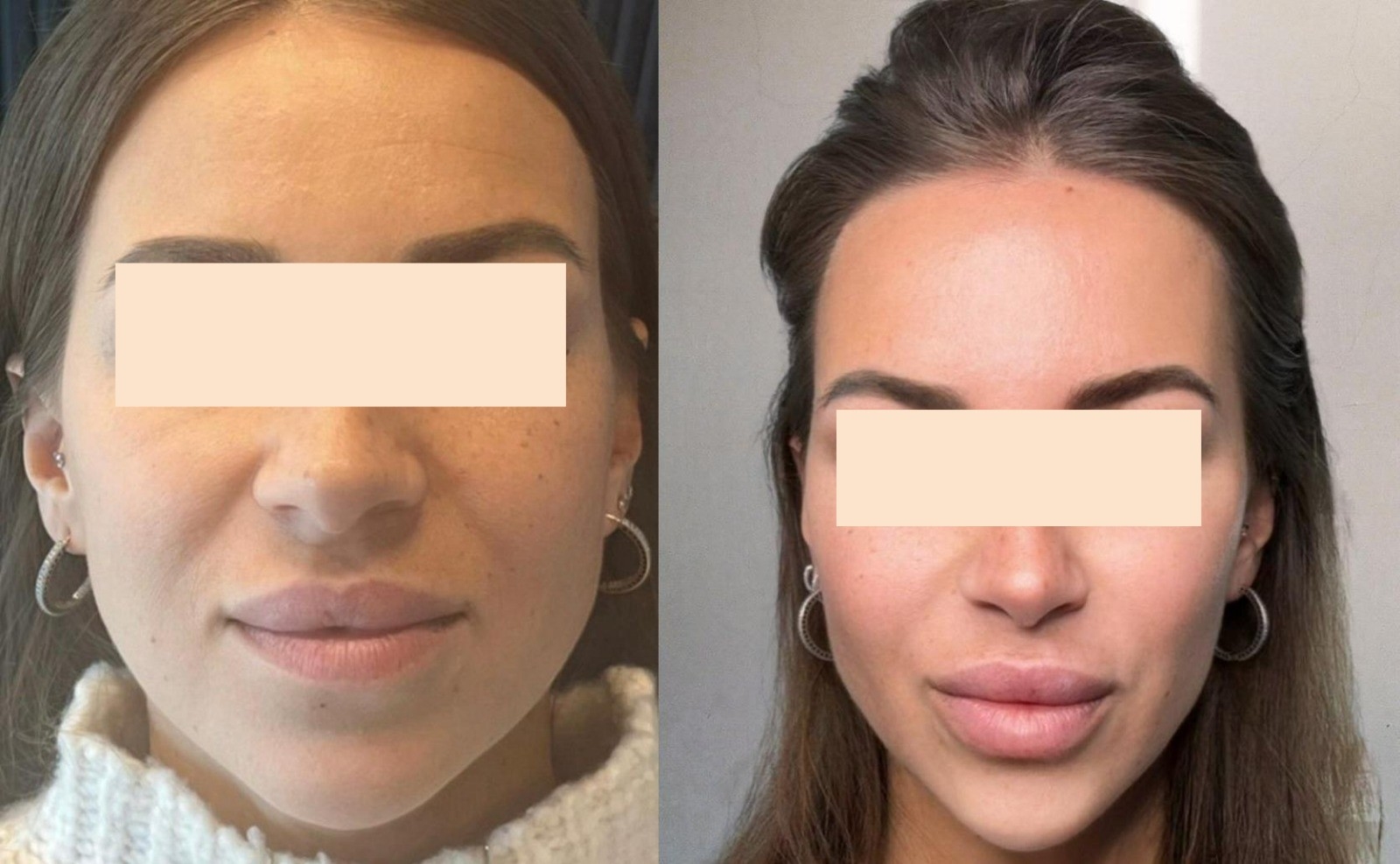 לפני ואחרי - שיפור מרקם העור