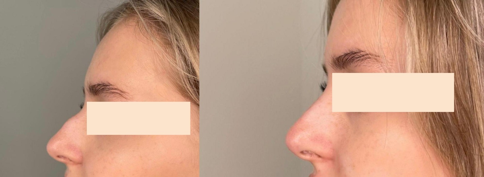 לפני ואחרי - עיצוב שפתיים