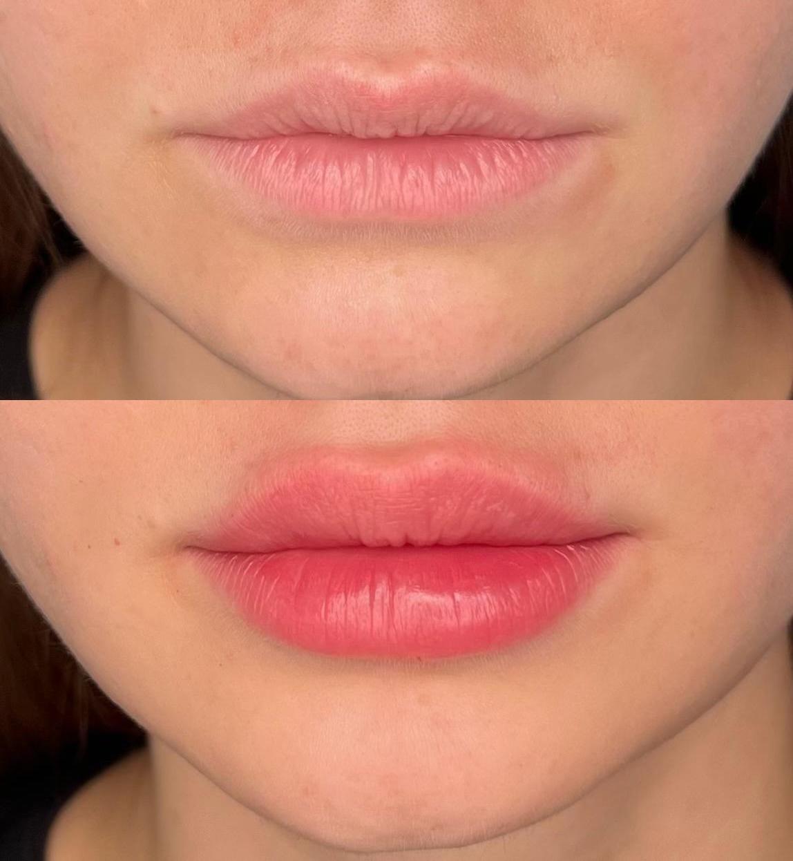 לפני ואחרי - עיצוב פרופיל פנים