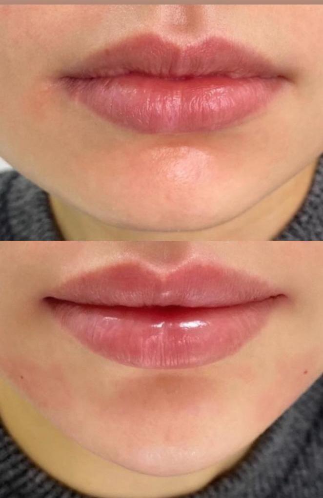לפני ואחרי - מילוי שפתיים